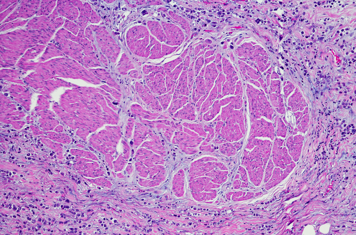 Plasmacytoid variant of urothelial carcinoma