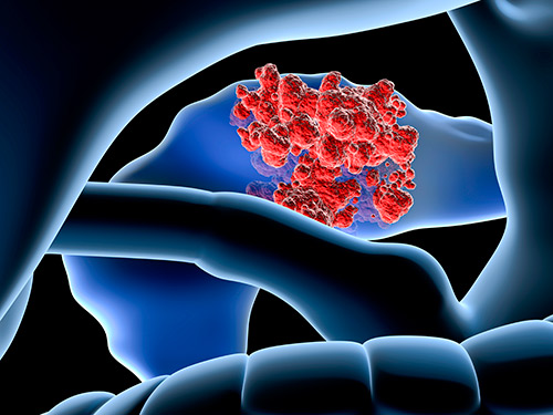 Illustrated image depicting blood cancer