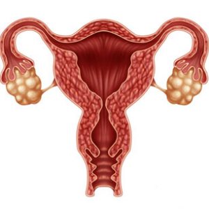 Extra Surveillance for Women at Risk of Ovarian Cancer Can Be Effective in Short Term