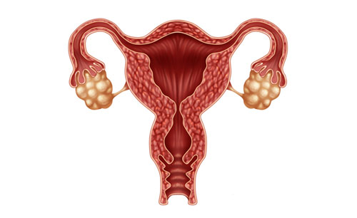 Illustration of female reproductive system including uterus and ovaries to represent ovarian cancer