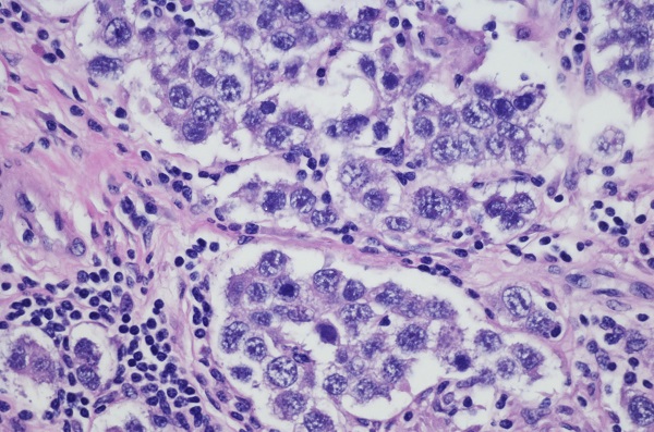 Micrograph of ovarian dysgerminoma