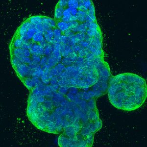 Single-Cell Sequencing Tool Yields Insights into Breast Cancer