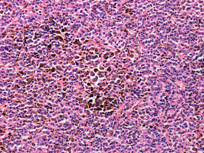 Secondary liver cancer, light micrograph