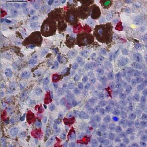 Melanoma Mutation Hides in Tumor, Poised to Thwart Treatment