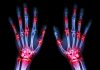 Real World Study Confirms JAK Inhibitors Effective Treatment for Rheumatoid Arthritis