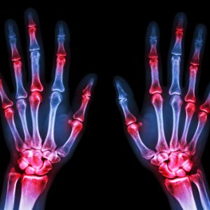 Genome-Engineered Cell Implant for Autoregulated Arthritis Treatment