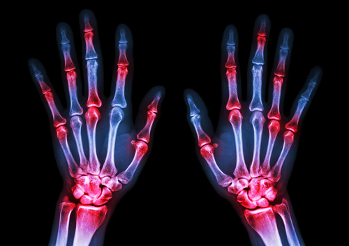 two hands viewed in X-ray format showing red areas of inflammation around the joints to indicate osteoarthritis