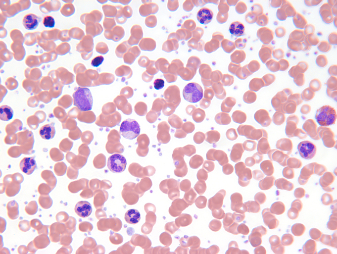 Chronic myelogenous leukemi
