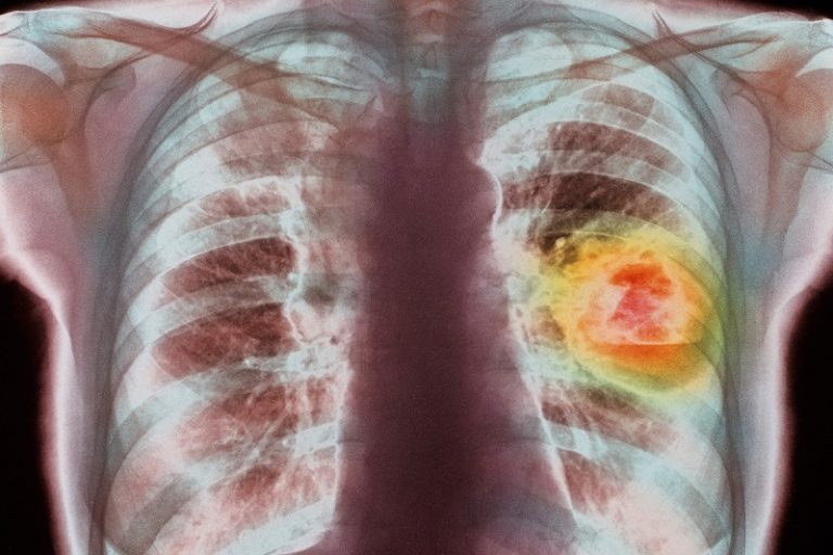 Protein Uncovered Implicated in Lung Cancer Resistance to TKIs