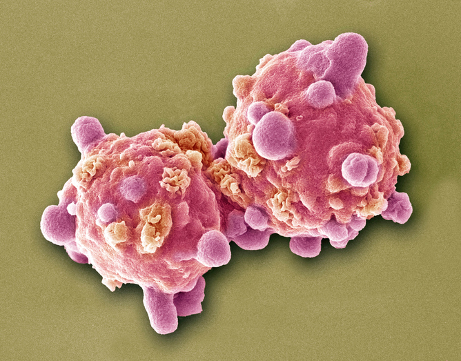 Leukemia white blood cells, scanning electron microscope (SEM)