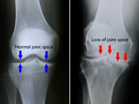 The Foundation for the National Institutes of Health (FNIH) Biomarkers Consortium has launched a project designed to seek regulatory qualification of new biomarkers that predict the change in joint damage over time from osteoarthritis (OA) in the knee. [Source: American Academy of Orthopaedic Surgeons]