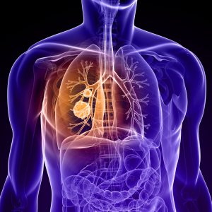 Severe Chemotherapy Side Effects in NSCLC Predicted