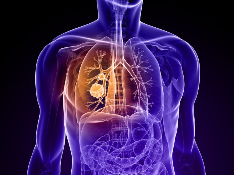 Biocept to Study Clinical Utility, Cost Effectiveness of Assays in NSCLC Patients
