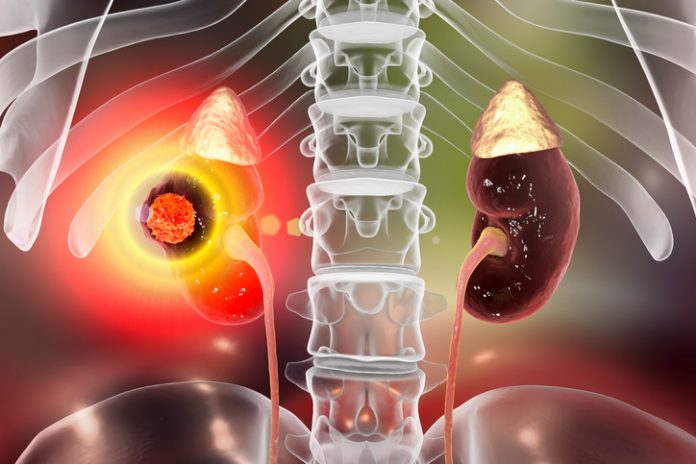 Kidney cancer treatment, conceptual illustration