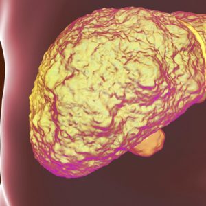 Oral Microbiome Therapy May Improve Cirrhosis Symptoms