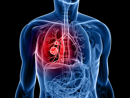 Circular RNA Identified as Potential Drug Target for Lung Squamous Cell Cancer