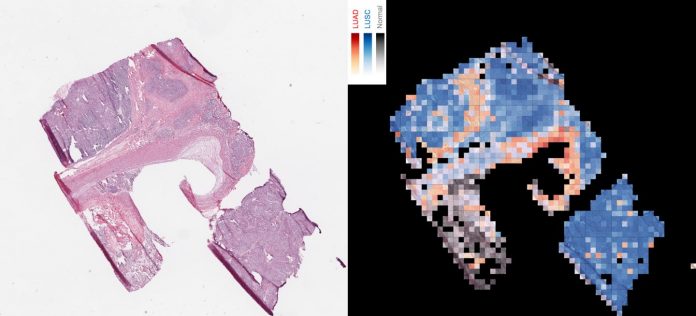 The image shows how an AI tool analyzes a slice of cancerous tissue to create a map that tells apart two lung cancer types