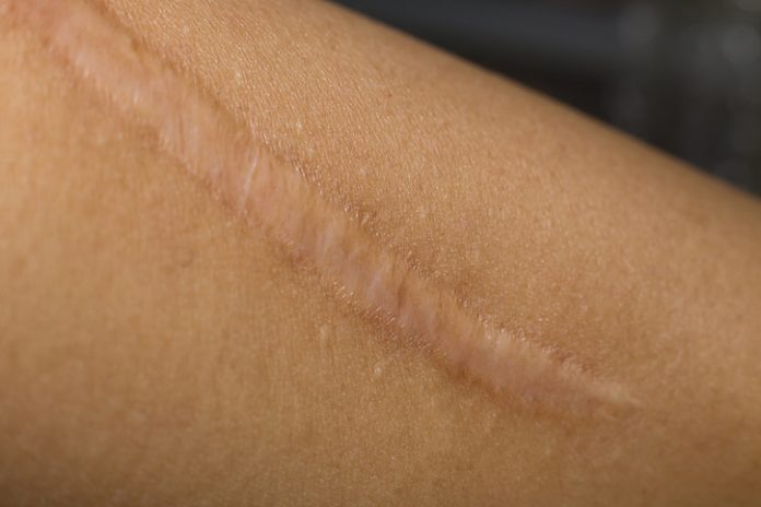 A Keloid on skin Body closeup image