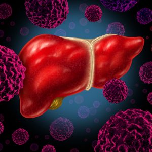 Liver Cancer’s Metabolism Offers a Novel Therapeutic Strategy