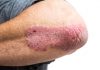 Psoriasis Inflammation: CHI3L2 Emerges as a Potential Therapeutic Target