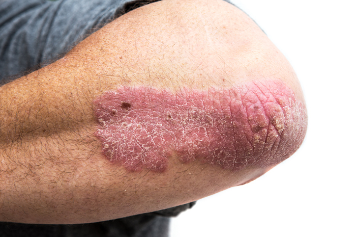 psoriasis on a middle aged man's elbow