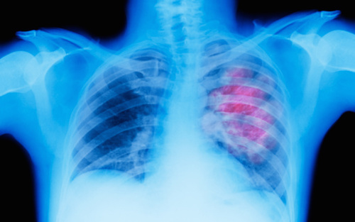 Epigenetic Regulation to Treat Lung Cancer May Instead Support Progression