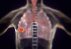 Combination Immunotherapy More Effective in Neoadjuvant NSCLC