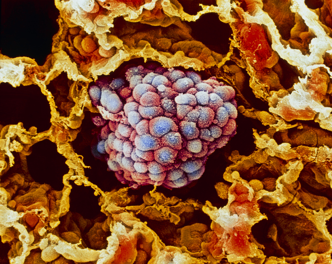 Lung cancer, close-up