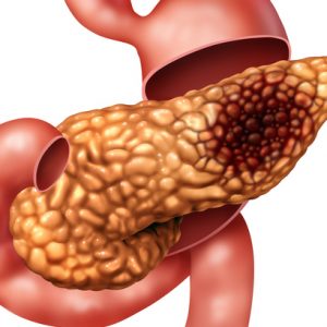 Immune Cell Specific to Women with Pancreatic Cancer Suggests Possible Sex-Specific Treatments