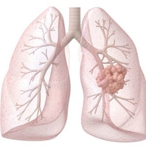 Exact Sciences, MD Anderson Partner to Develop Lung Cancer Diagnostics