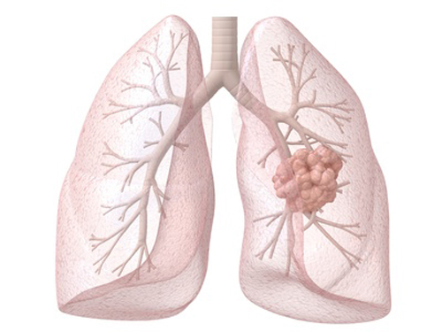 Exact Sciences, MD Anderson Partner to Develop Lung Cancer Diagnostics