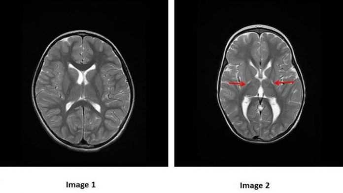 Image 1: MRI of the brain of a healthy child: gray matter is pale gray and white matter is dark gray. Image 2: MRI of the brain of a child with cerebral palsy: red arrows show scarring over the central gray matter leading to stiffness and problems in the coordination of movements. [McGill University Health Centre]