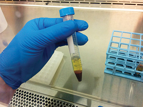 A researcher at Stanford University holding a tube of blood after centrifugation. The pale yellow liquid on top is blood plasma containing cell-free DNA. Cell-free DNA in easy-to-obtain samples such as blood or urine is revolutionizing precision medicine approaches in many fields of medicine including oncology