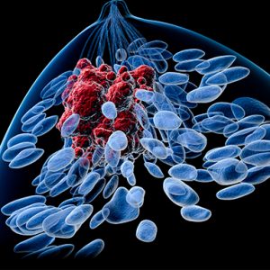 Finer Cancer Screens Catch More Cancer Clues