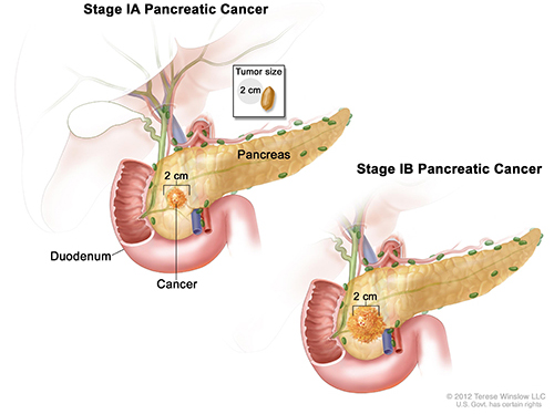 Researchers discover new set of biomarkers for early detection of pancreatic cancer [NIH]