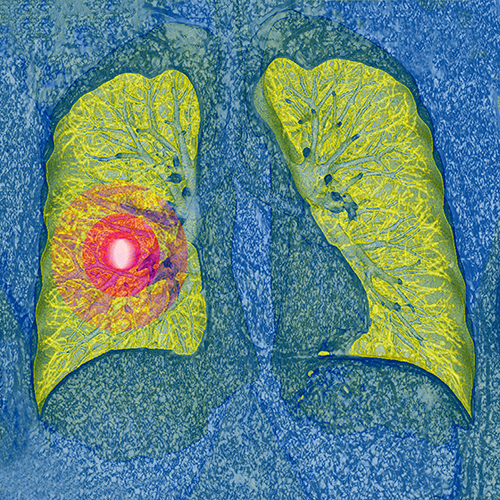 First-line Atezolizumab Improves Survival in Platinum-Ineligible NSCLC