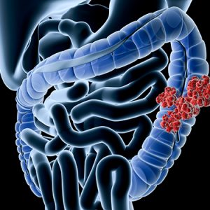 Deep-Learning Algorithm Differentiates Colon Cancer from Diverticulitis