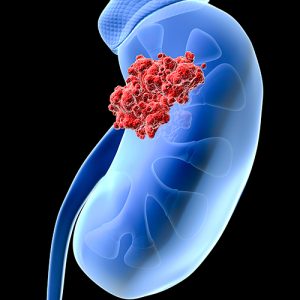 Gene Profiling May Help Identify Renal Cancer Patients Unlikely to Benefit from Immunotherapy