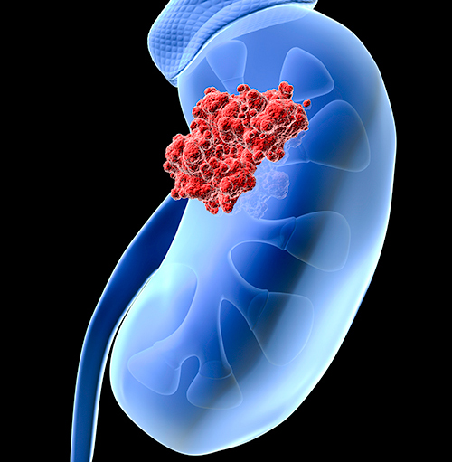 Gene Profiling May Help Identify Renal Cancer Patients Unlikely to Benefit from Immunotherapy