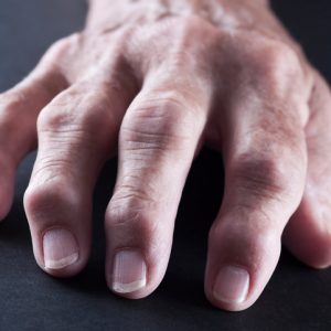 Researchers Detail Genetic Underpinnings of Rheumatoid Arthritis