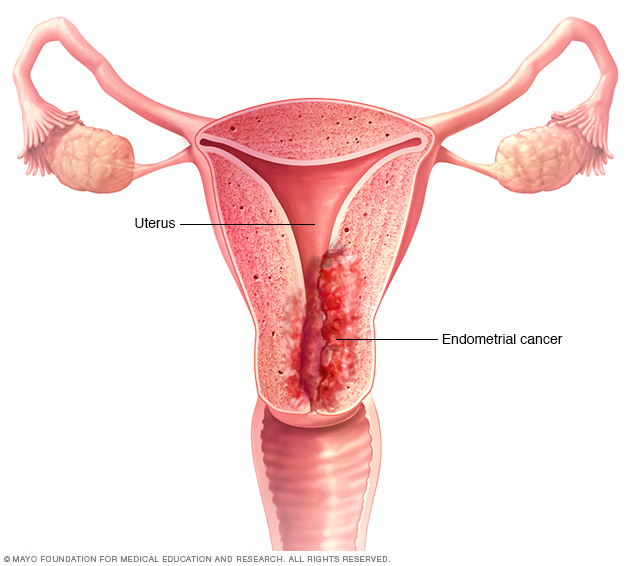 Cell-Free DNA Reveals Endometrial Cancer Mutations Before Diagnosis