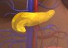 Biomarkers ID Risk of Pancreatic Cysts Developing into Cancer
