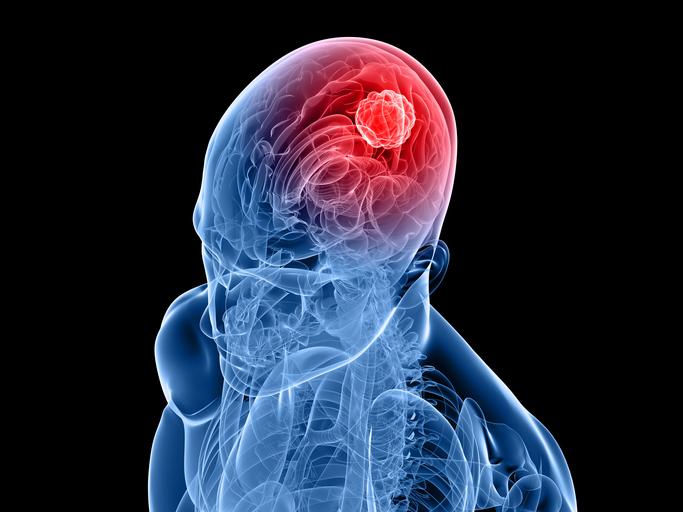 A 3-D image of a human skull and brain depicting cancer