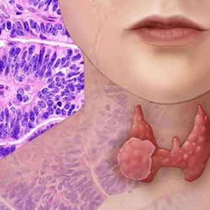 Less Is More: UPMC Clinical Trial to Examine If More Precise Molecular Profiling of Thyroid Cancer Patients Can Decrease Thyroidectomies