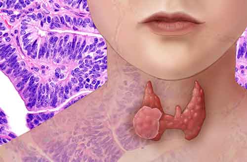 While thyroid cancer is very treatable with surgery and other therapies