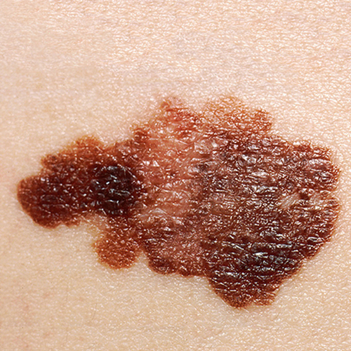 Close up of skin cancer