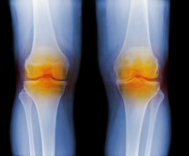 Arthritic knees, X-ray