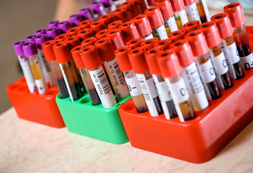 Blood Test that Measures Expression of 5,000 Proteins Shows Potential as Disease Screening Tool