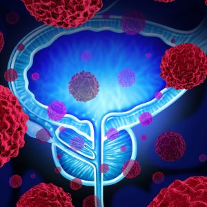 Hormone-Sensitive Prostate Cancer Patients Survival Improved with Combination Therapy