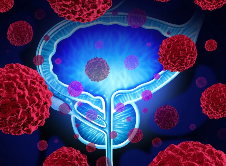 Illustration of the prostate organ in blue surrounded by red cancer cells to symbolize prostate cancer